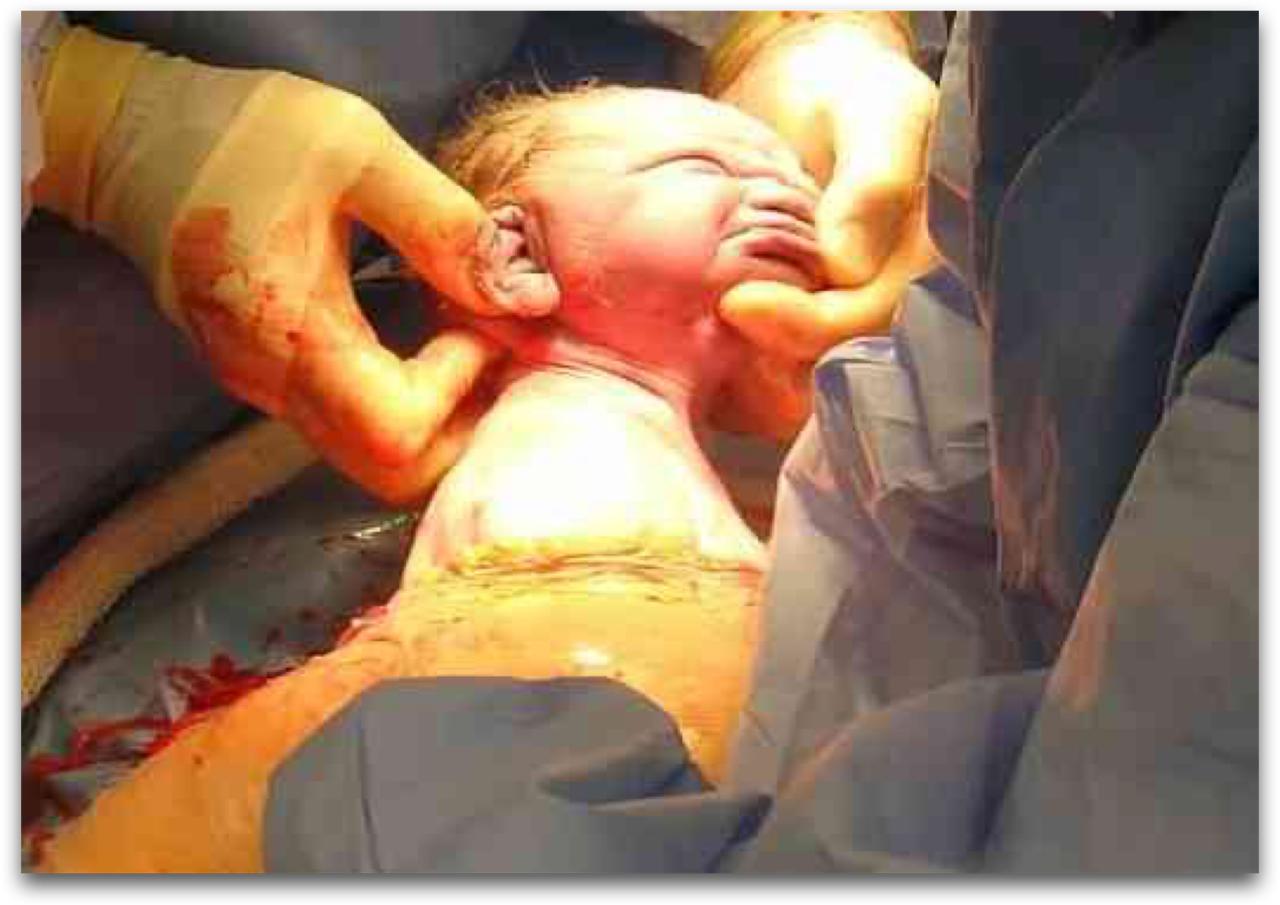 A newborn moments after a cesarean delivery